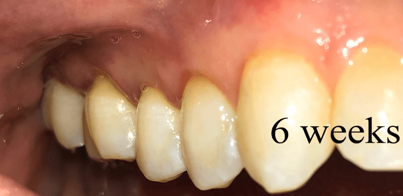 Gum Surgery for receding gums After