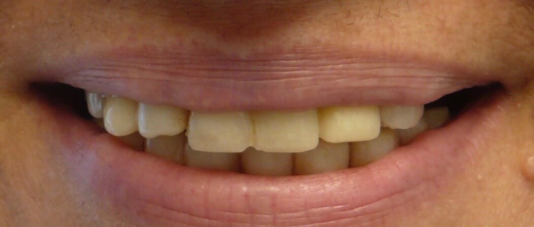 Before and After Smile Before