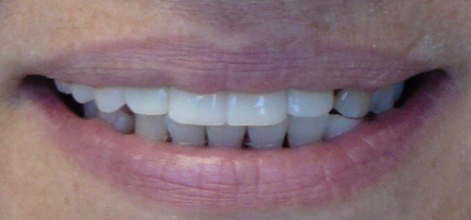 Before and After Smile After
