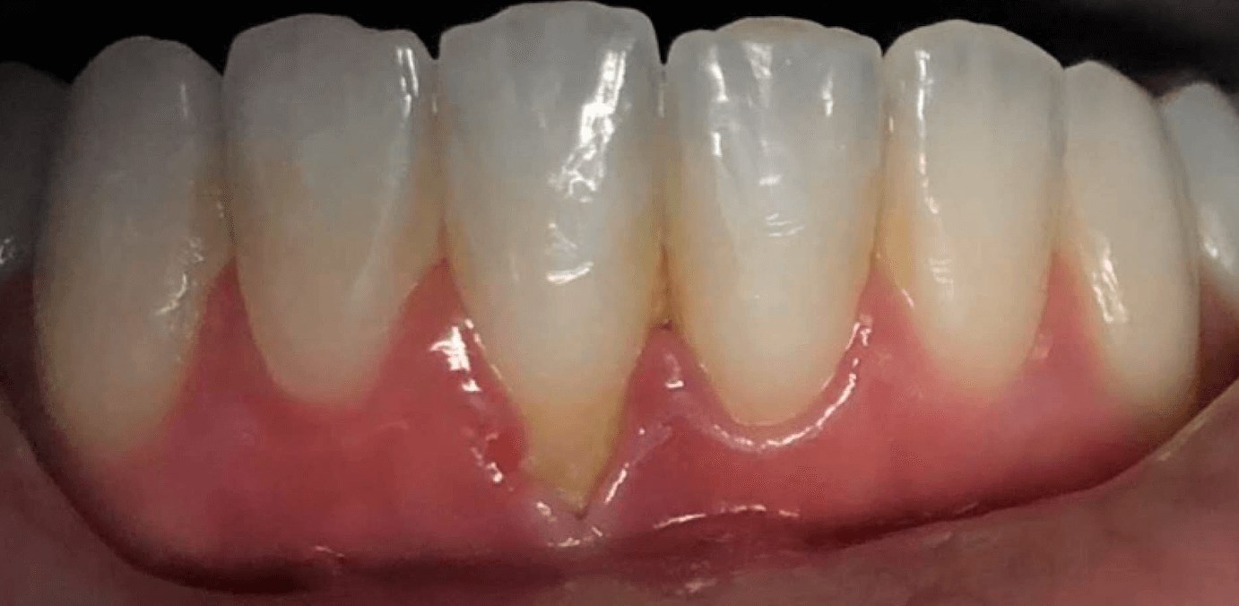 Pinhole Technique Gum Surgery  Before