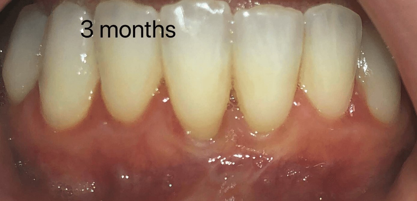 Pinhole Technique Gum Surgery  After