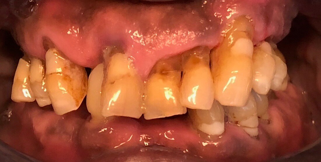 Implants for Full Mouth Recons Before