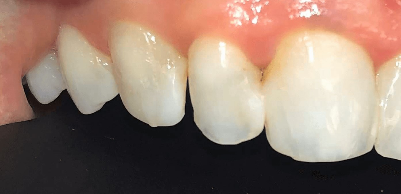 Veneers Before and After Before
