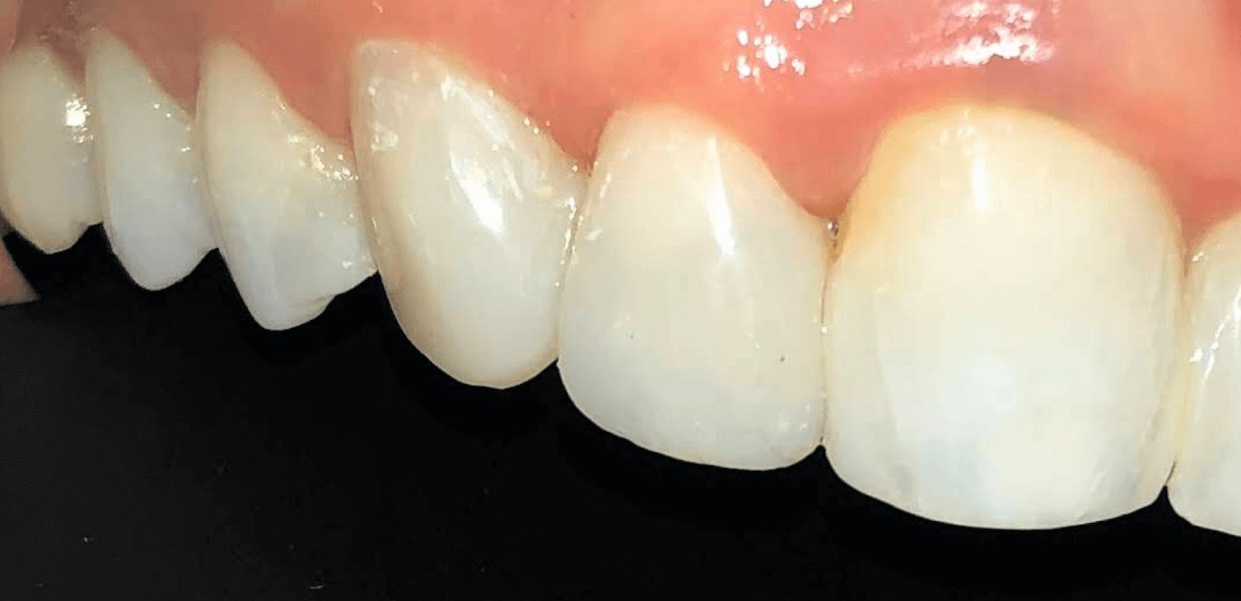 Veneers Before and After After