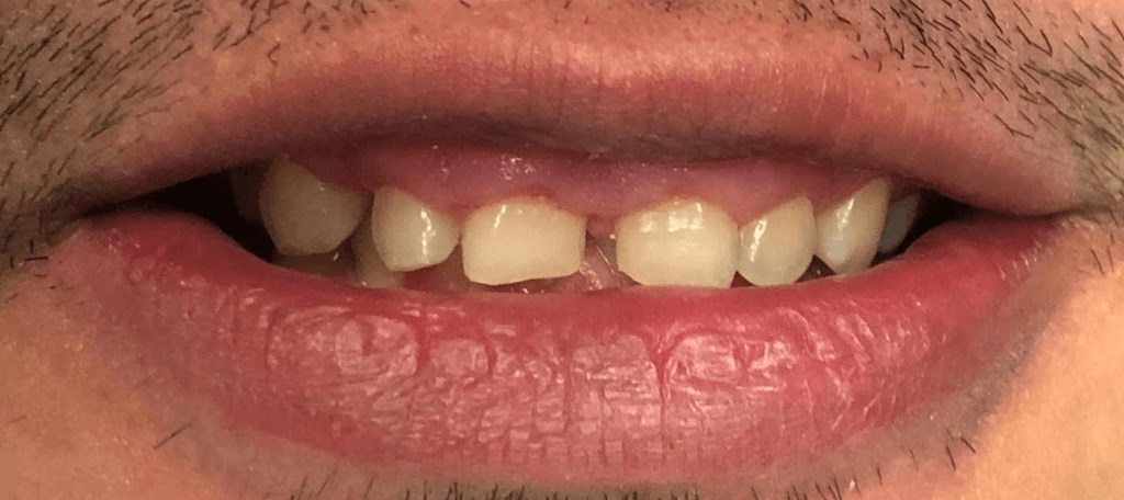 Veneers Before and After Photo Before