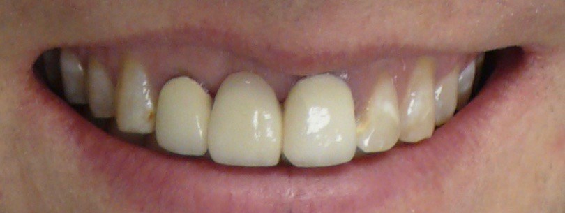 Dental Implants Before & After Before