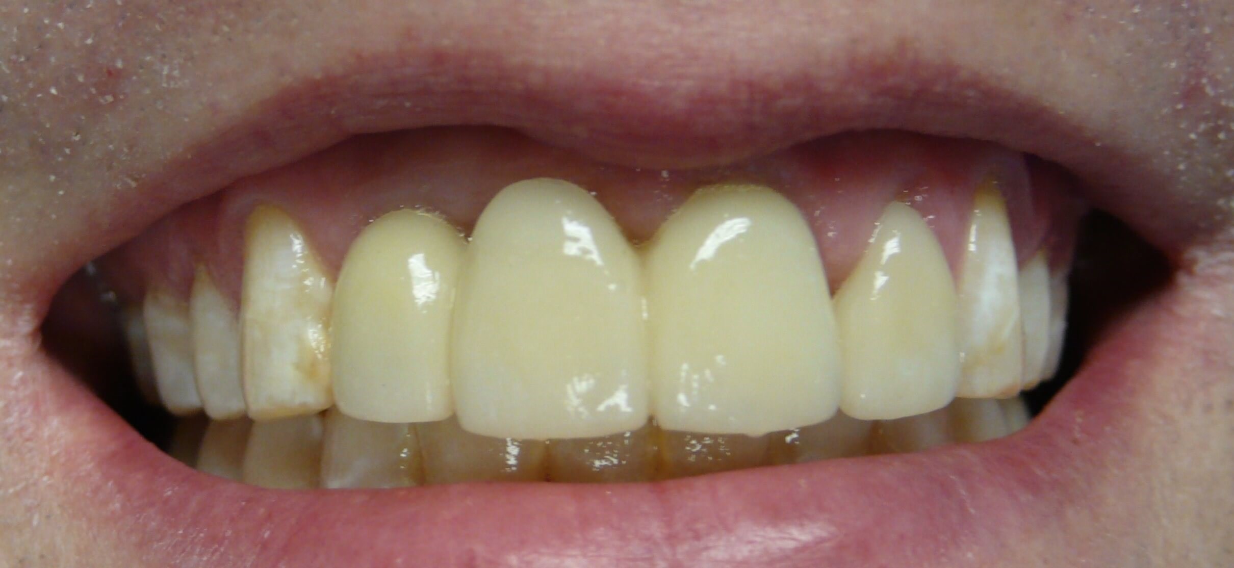 Dental Implants Before & After After