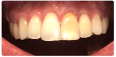 Teeth Whitening and Crown Before