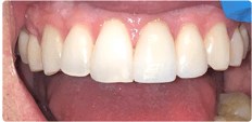 Teeth Whitening and Crown After