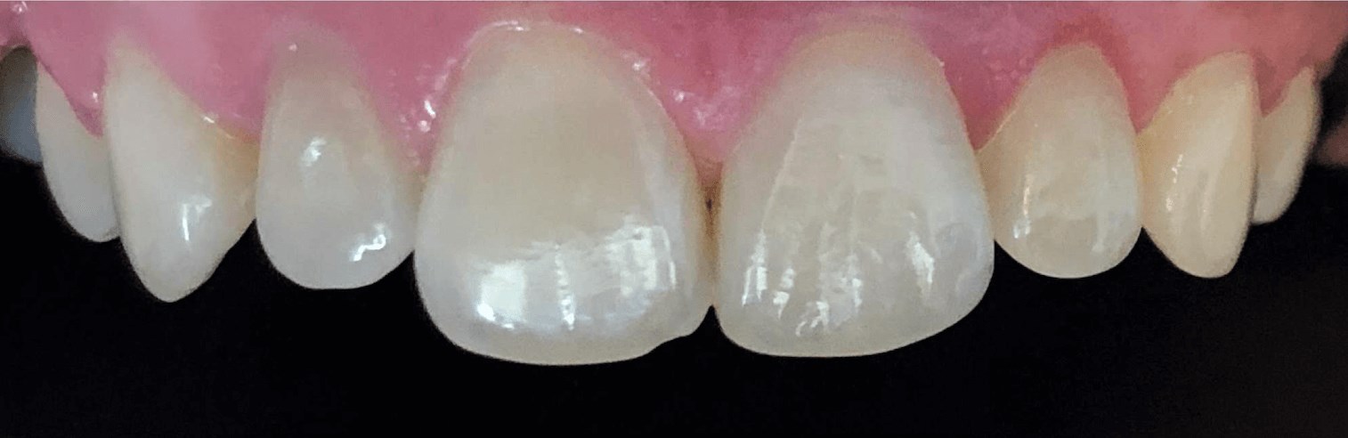Dental Crowns Before & After In Treatment
