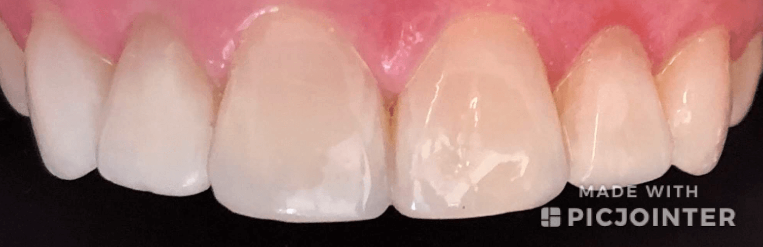 Dental Crowns Before & After After