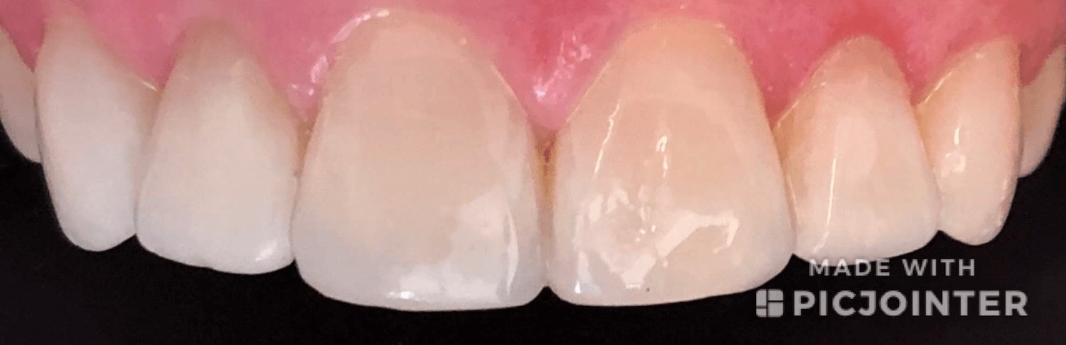 Dental Crowns Before & After After